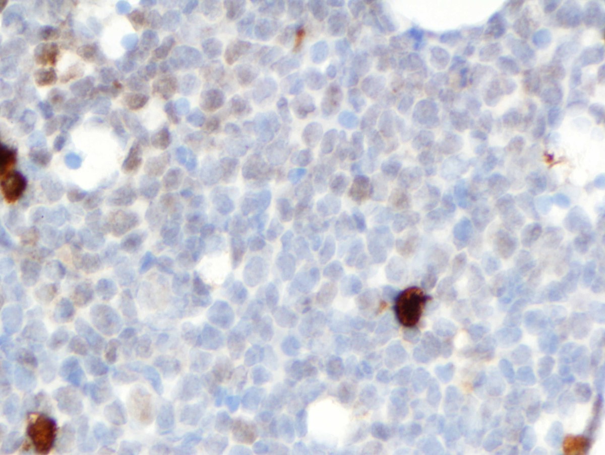 E. Bone marrow core biopsy showing rare monocytic cells (dark cytoplasmic staining) and patchy, artifactual nuclear blush on the blast cells (muramidase, 500x).